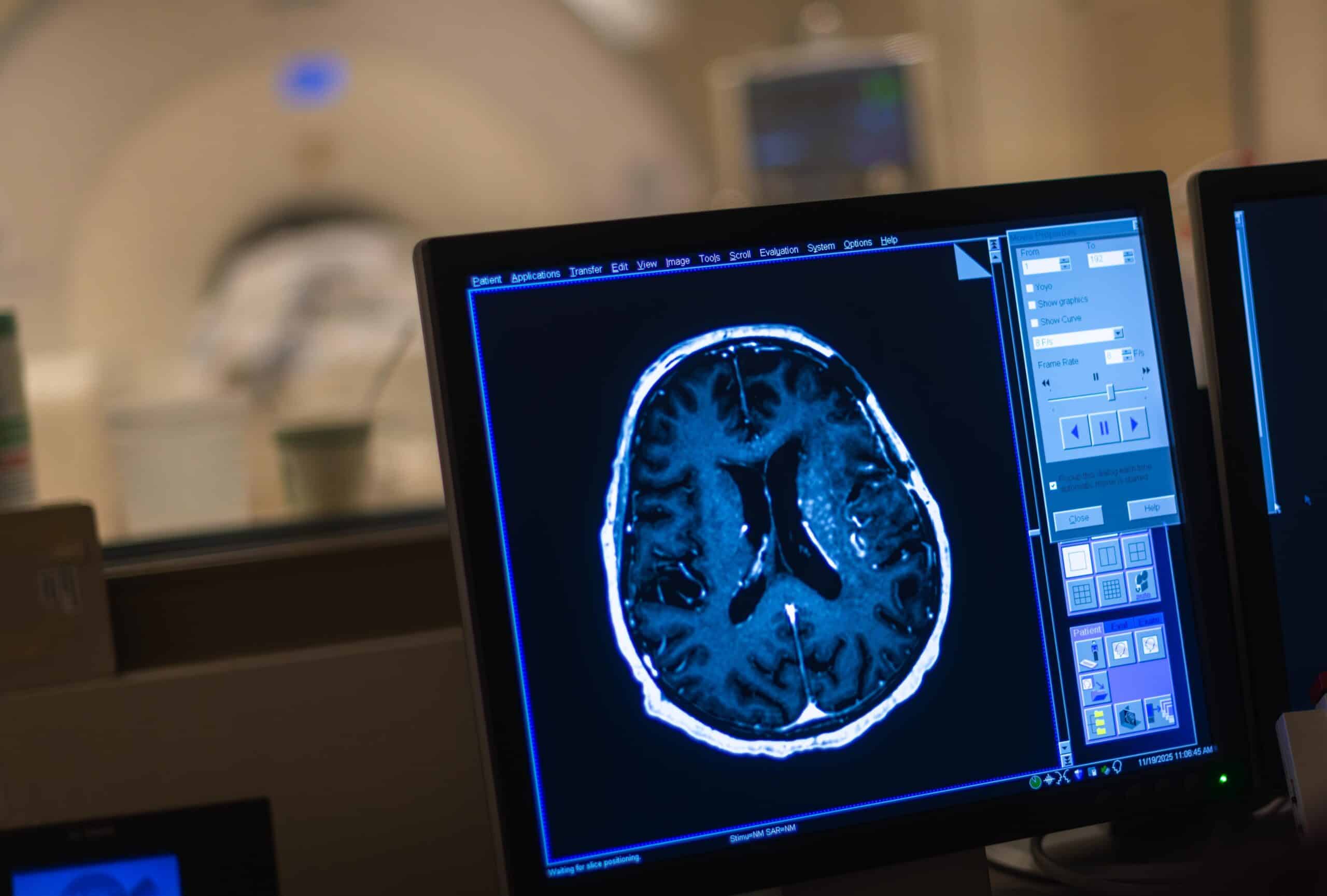 MRI of a patient's brain on a computer screen